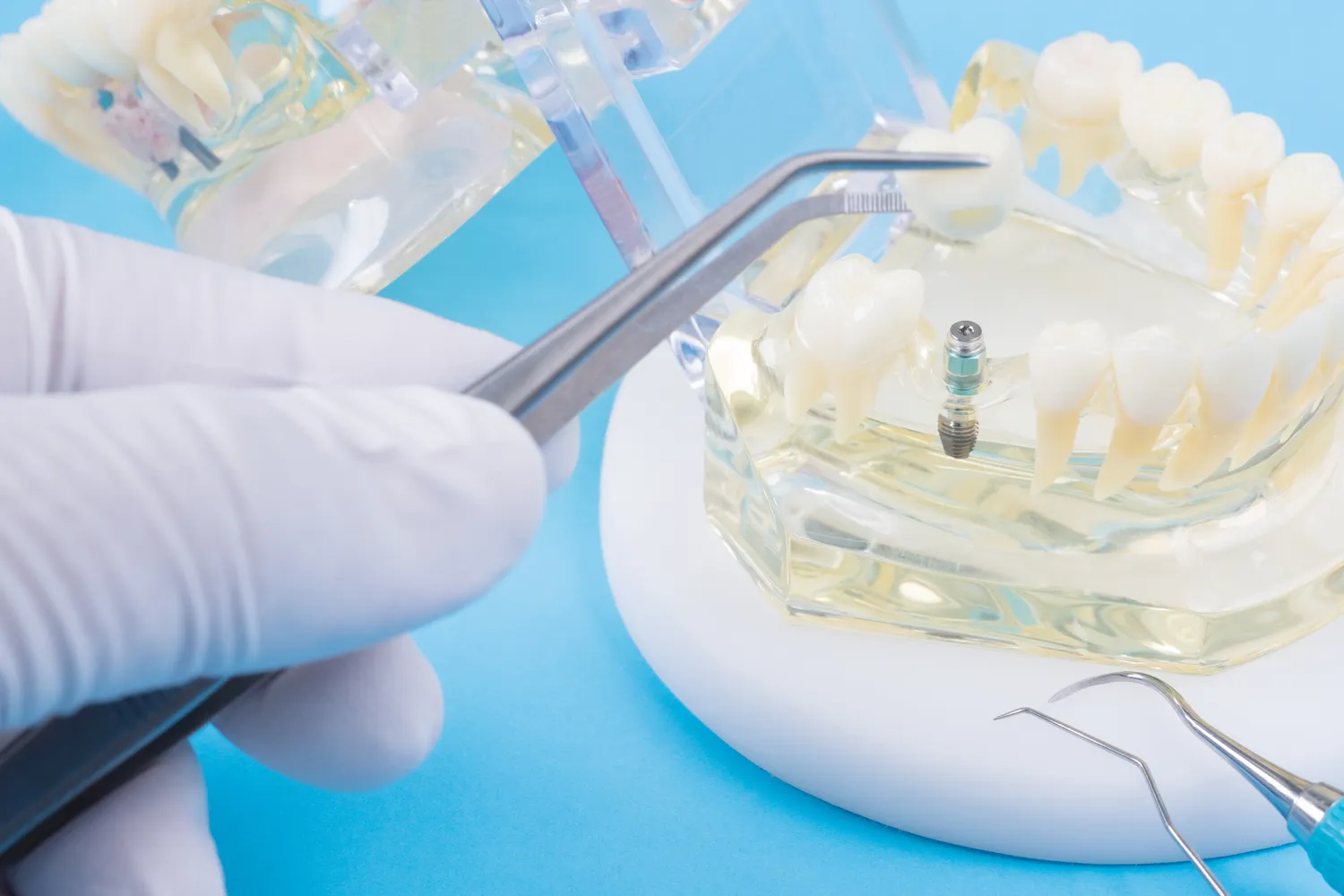 Ile wizyt trwa leczenie kanałowe zęba?